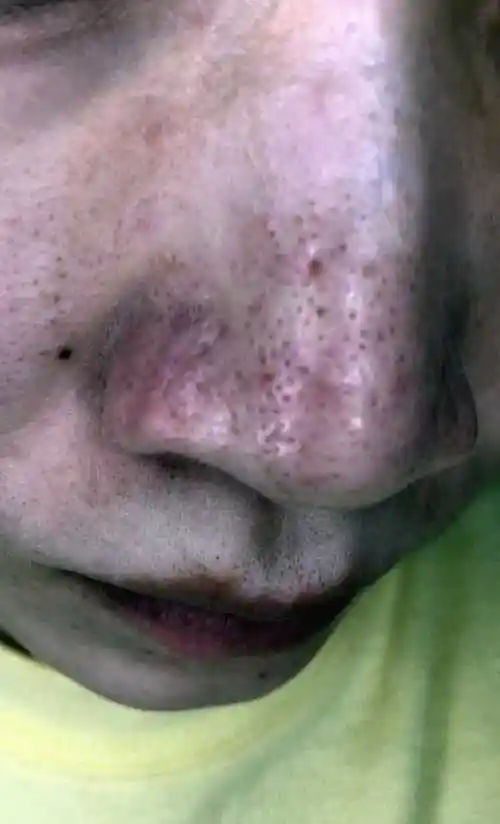 自己挤黑头后鼻子揭掉一层薄薄的皮,然后有个红印,有没有一样情况的知