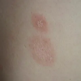 这是什么皮肤病