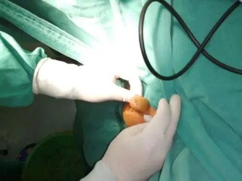 患者包茎前尿道狭窄