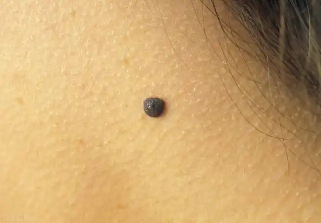 其实大多数色素痣并不会有损身体健康,这只不过是表皮或真皮内黑素