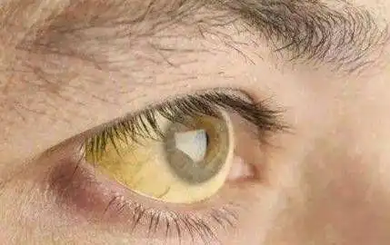 肝不好的人,眼睛可能会出现这三种症状,希望没有你,不妨自测_网易订阅