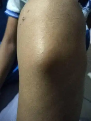 膝盖下鼓了一个包