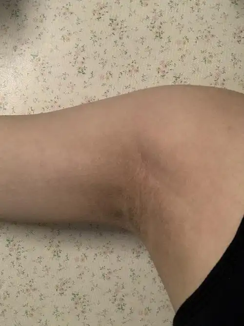 腋下总是很干黑黑的感觉像是垢藏在那里但是一扣就会出血结痂请问要