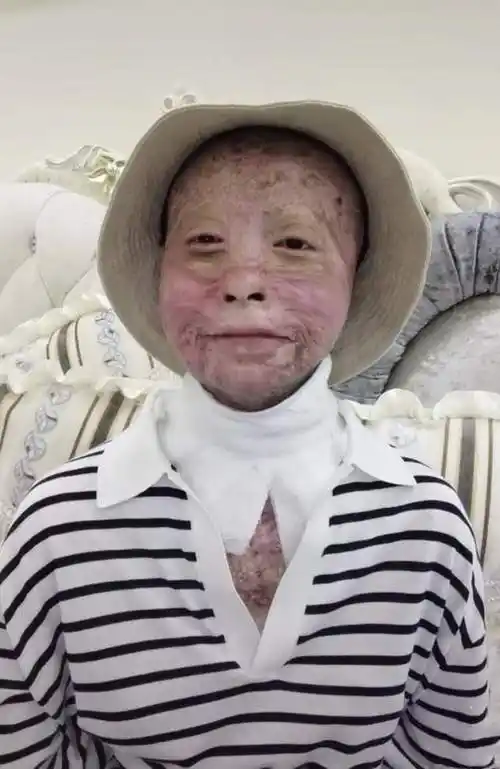 原创24岁女孩烧伤928天后重生做12次手术仍不放弃河南灾情捐500元