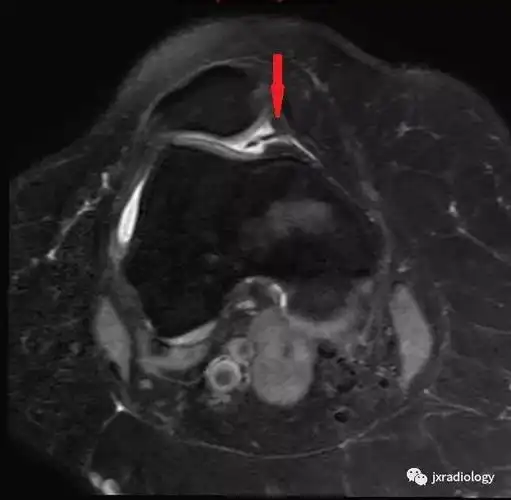 髌内侧滑膜皱襞综合征