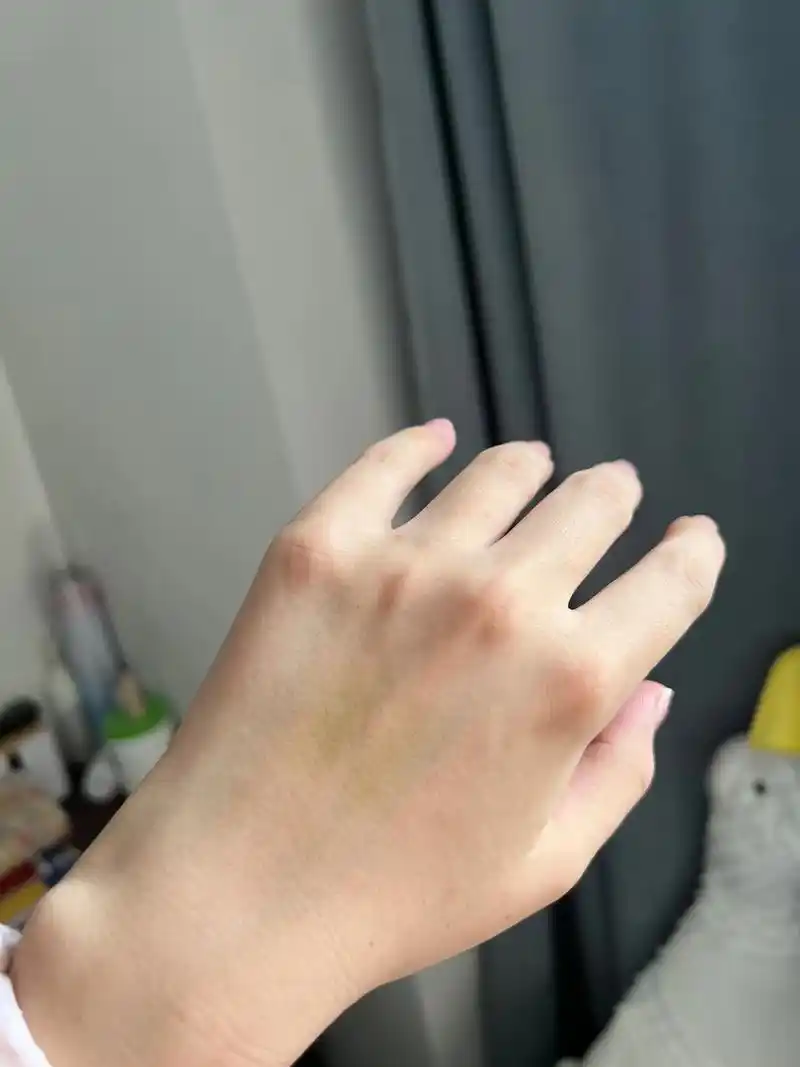 今天突然发现手上的淤青还没好08月子第 19 天～ 带娃真的很容易