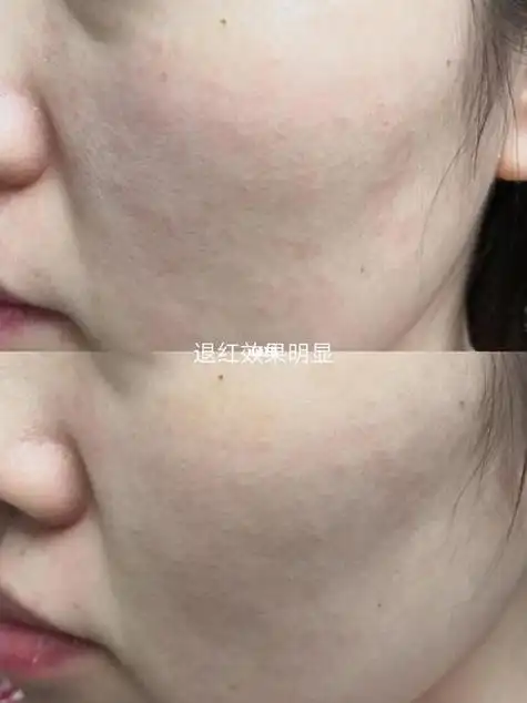 光子嫩肤5次后红血丝图(医院做一次光子嫩肤多少钱)