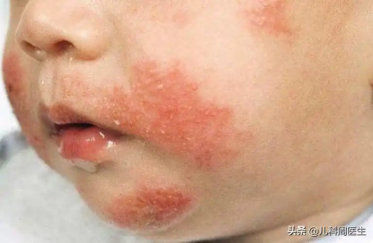 婴儿皮炎症状图片大全夏日长痱子