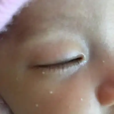 各位有经验的宝妈,宝宝马上两个月了为啥脸上还有小白点,在月子就有