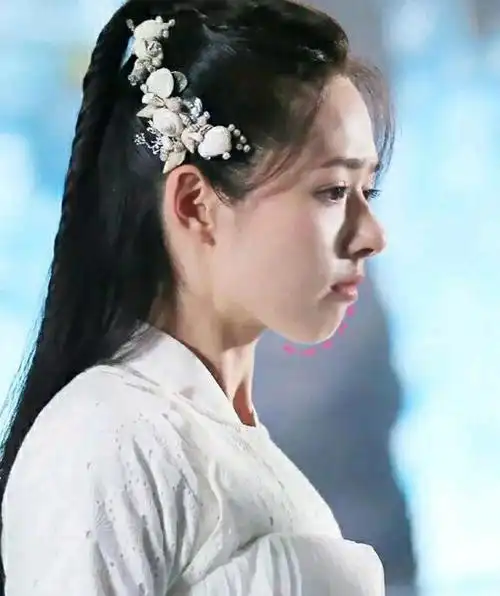 下巴后缩如何改善?