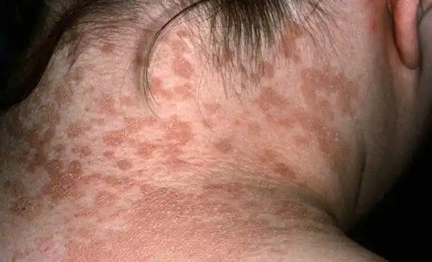 汗斑严重时还容易激发细菌或者真菌感染好发于肥胖者和婴儿主要由于