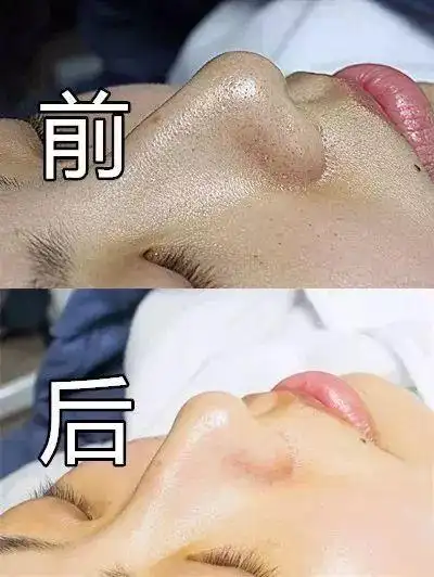 9元秒杀火上天的韩国小气泡,还你一张高清脸!附小编体验前后对比!