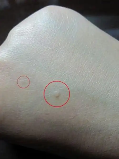 丝状疣的对比图片