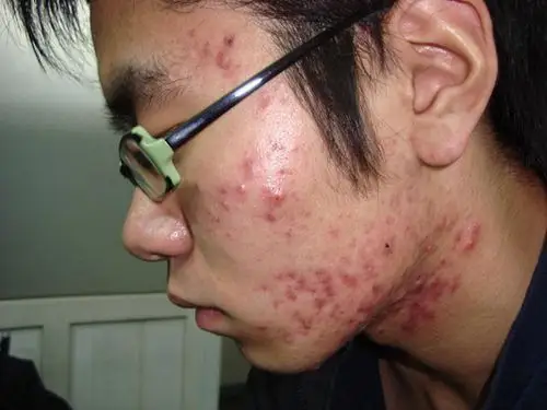 血热的症状痘痘图片8