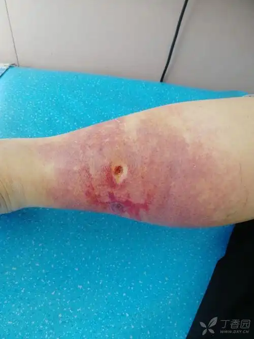 因"蜱虫咬伤后一日"前来我院,门诊予以手术切除.