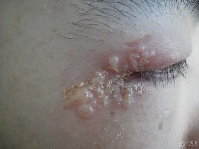 复发性单纯疱疹. - 皮肤及性传播疾病讨论版 - 爱爱医医学论坛