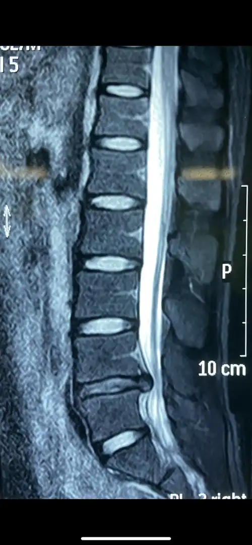 经皮微创治疗腰椎间盘突出 - 好大夫在线