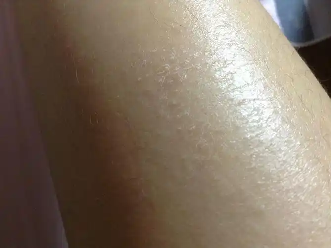 我的腿上皮肤最近起了一些白色的褶皱,摸起来很粗糙,怎么洗都洗不下来
