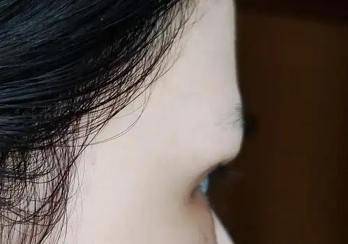 30天侧面,眉毛眼皮还是很厚重的.据说肿泡眼就这样.