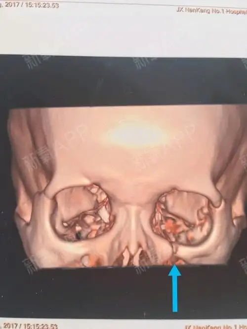 交通事故左颧骨骨折,至今八个月了,左脸有点塌陷下垂_圈子-新氧美容