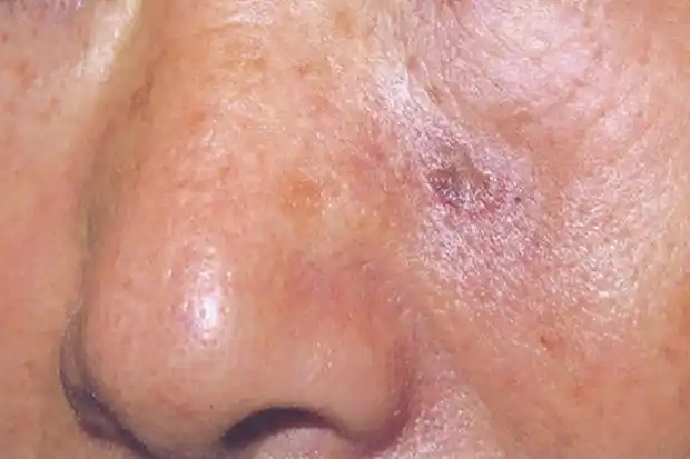 皮肤癌早期症状图片_有来医生