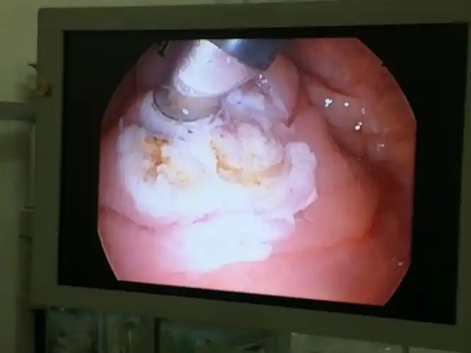 有这手术,局麻扁桃体圈套器摘除残酷术式应叫停了(中医院东区耳鼻喉科