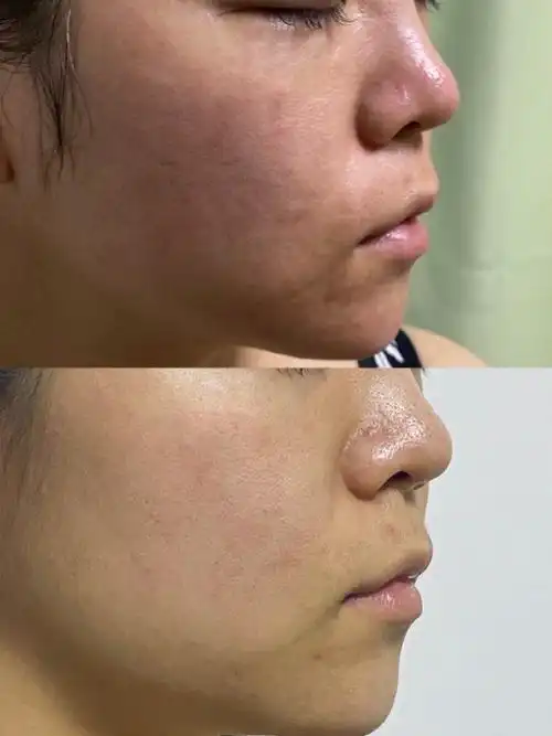 光子嫩肤术后一周,痘印淡化明显