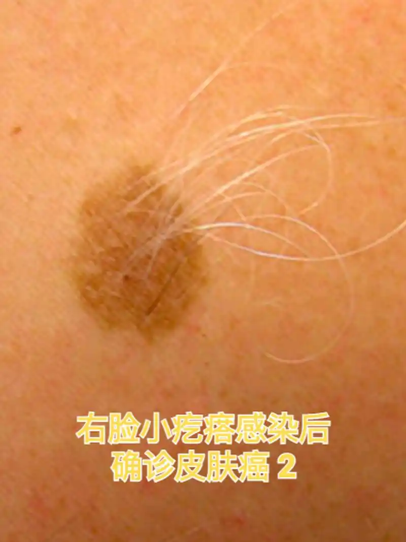 右脸小疙瘩感染后确诊皮肤癌 2 #皮肤癌# #疾病治疗经验# #健康经验