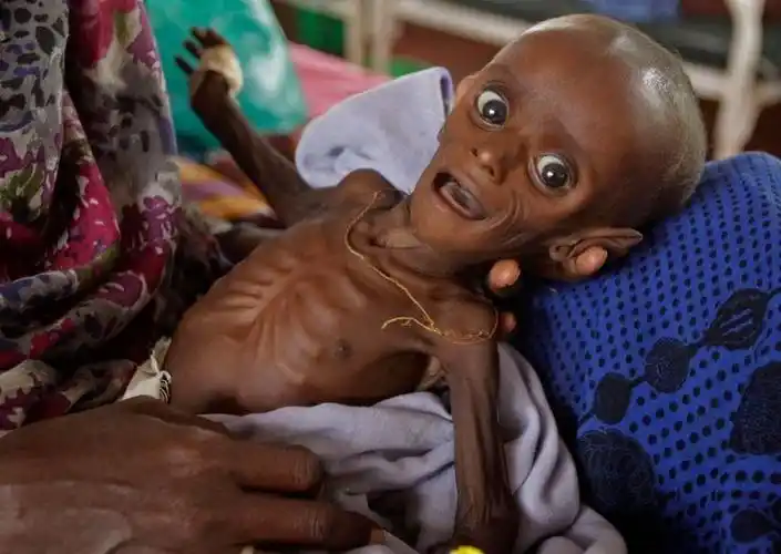 非洲东部地区遭遇干旱大批儿童死亡