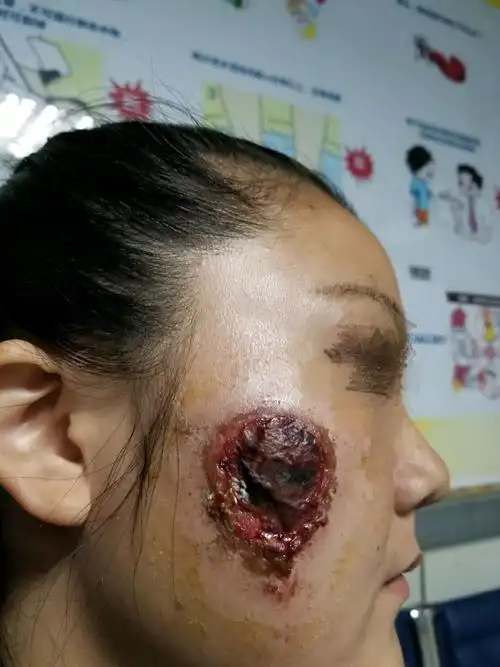面部化学试剂烧伤病例