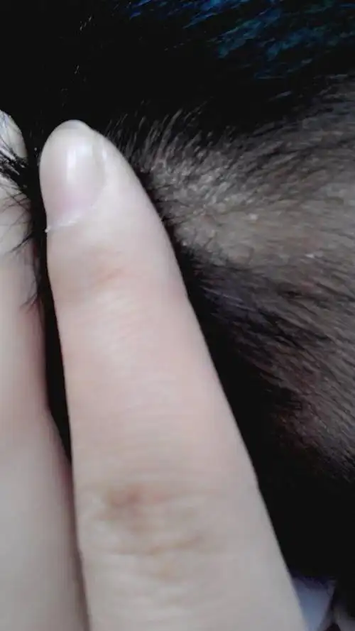 三个月宝宝头上长癣一样的白皮是怎么了?