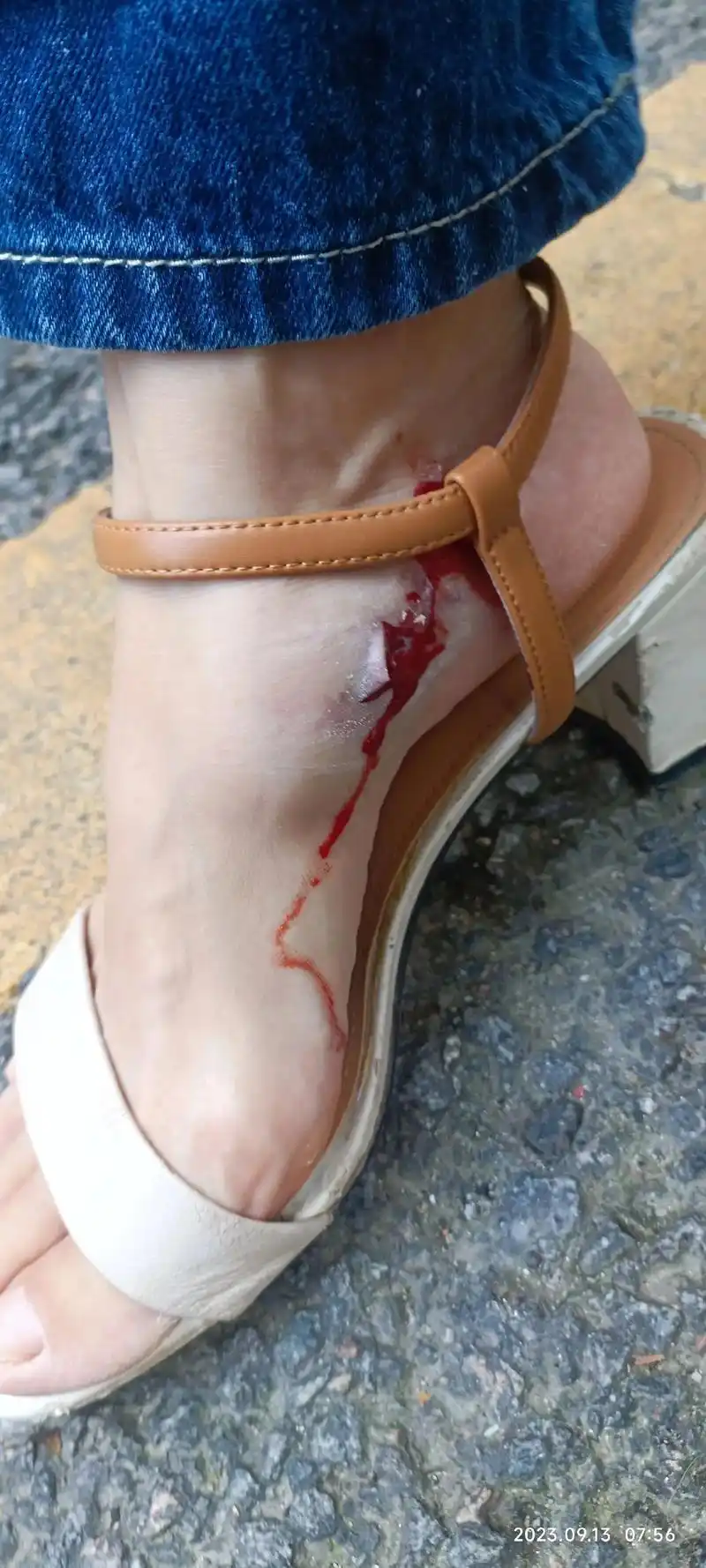 意外受伤 上班路上被逆行单车伤到脚,想着问题不大就让别人走 - 抖音