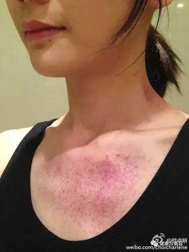 刘涛陈学冬的湿气重爱刮痧中国的神秘力量就这样震惊了世界