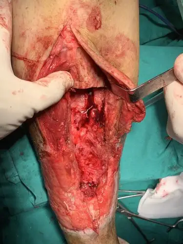 胫骨慢性骨髓炎,胫骨延长搬运术