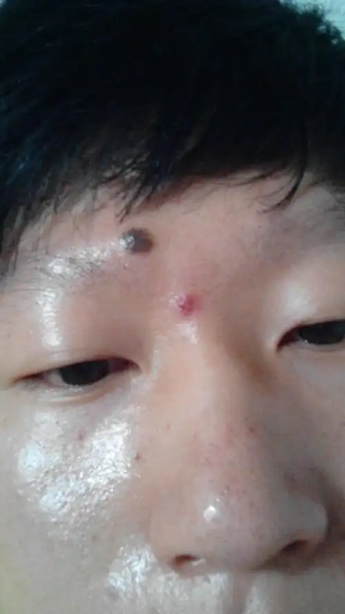 额头上一个胎痔