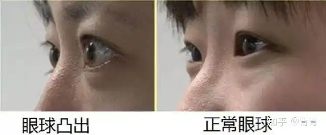 近视两三百度需要一直佩戴眼镜吗如果不戴会怎样