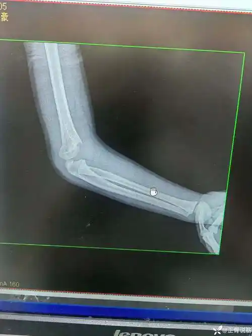 儿童肱骨髁上骨折保守治疗