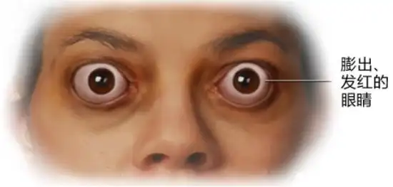 患者:甲亢突眼可以完全恢复吗?