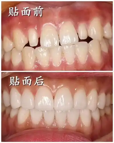 牙齿瓷贴面美白图片