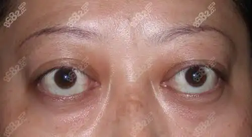 眼球因为近视突出了怎么办?哪里做突眼矫正效果比较好?