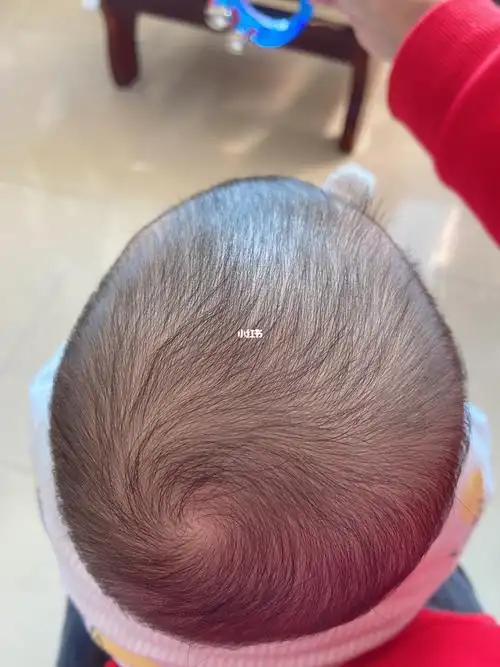 时候放在婴儿车睡觉把后脑勺还睡凹了一片#菱形头舟状头  ##宝宝头型