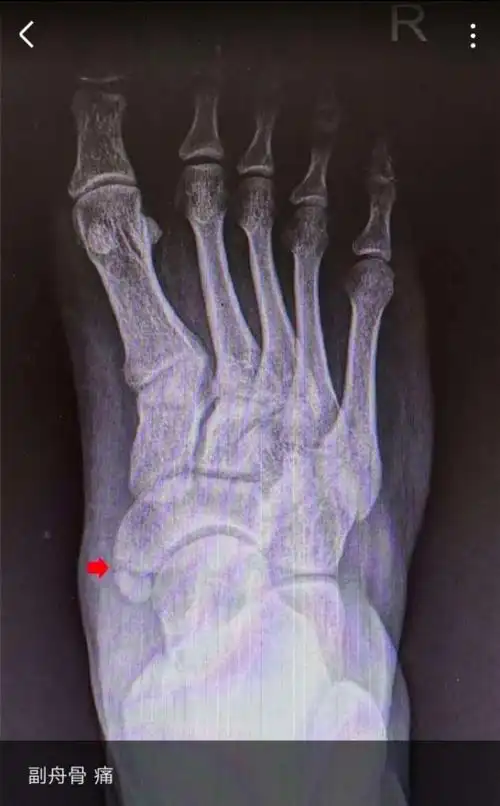 带您了解足"副舟骨"综合征