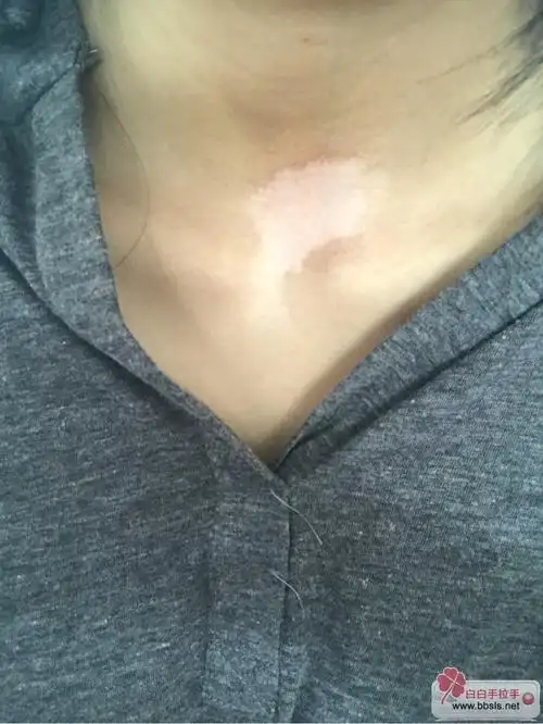 脖子上的白斑大概治疗多长时间才能看见效果