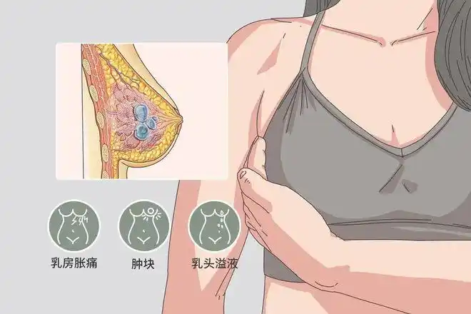 乳房肿块,还是体检时通过各种仪器发现的形态上不同于正常乳腺组织的