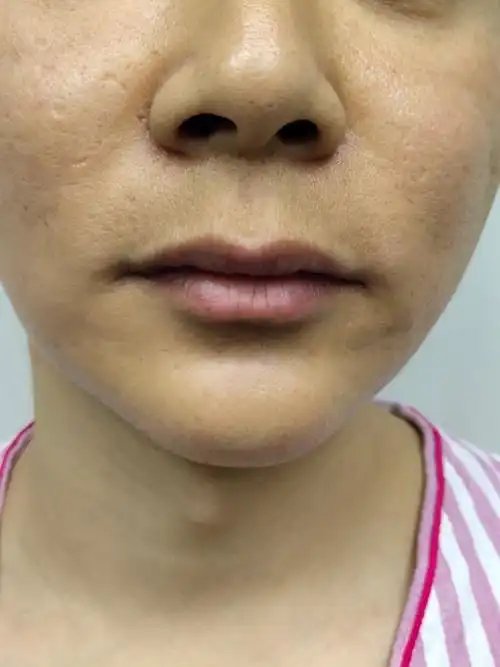 90人中缩短做完第一天啦,从来没有接触过医美形项目,_圈子-新氧美容