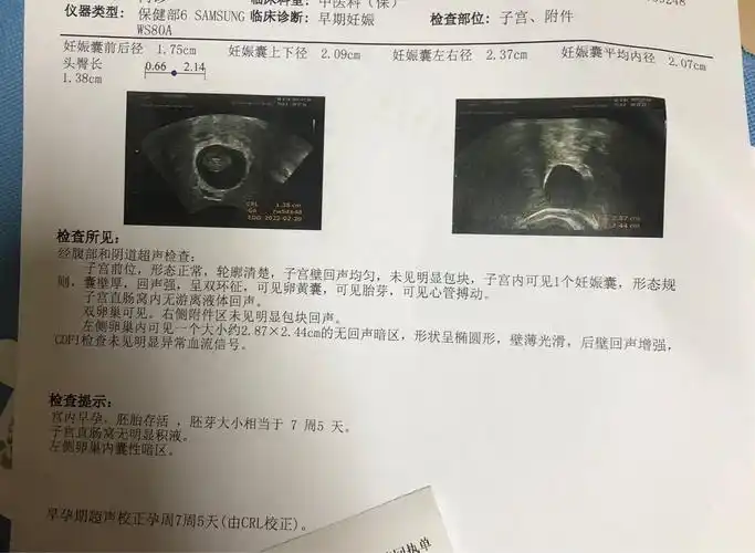 [试管婴儿]移植是第三十五天,孕囊1.75