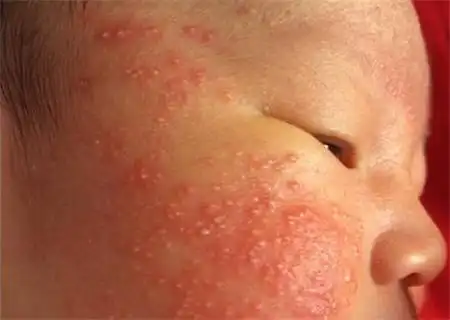 宝宝脸上是咋啦看到妈妈留言忍不住为宝宝捏把汗