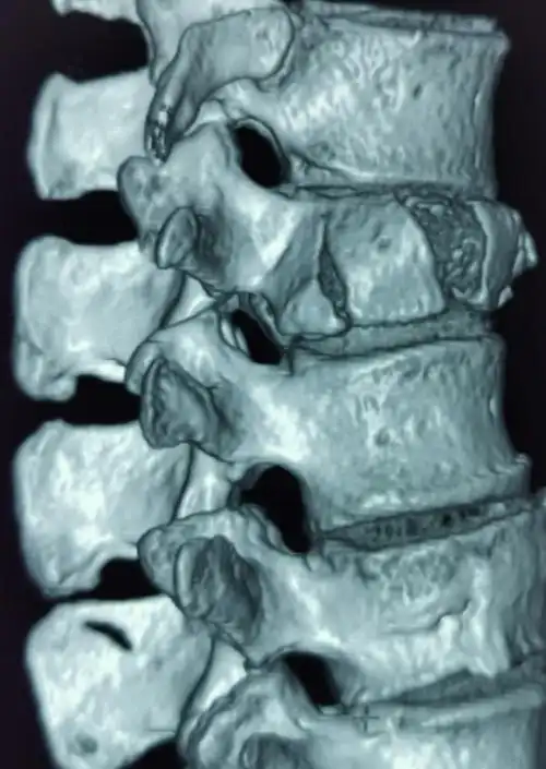 腰1椎体爆裂骨折(肌间隙入路)