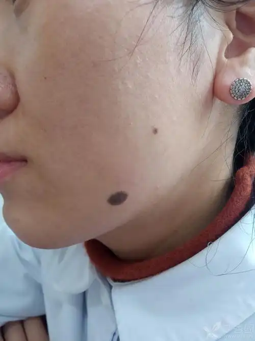 【讨论】这个面部黑痣如何设计