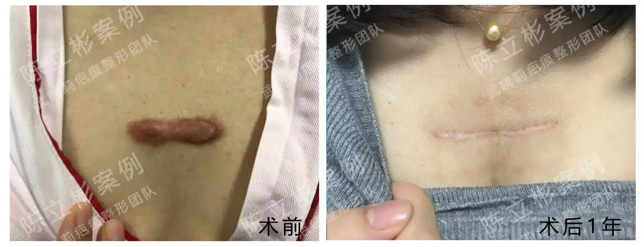手术案例│胸部疤痕疙瘩 - 好大夫在线